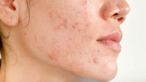 Science of Acne Scars